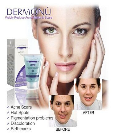 dermonu acne removal cream1